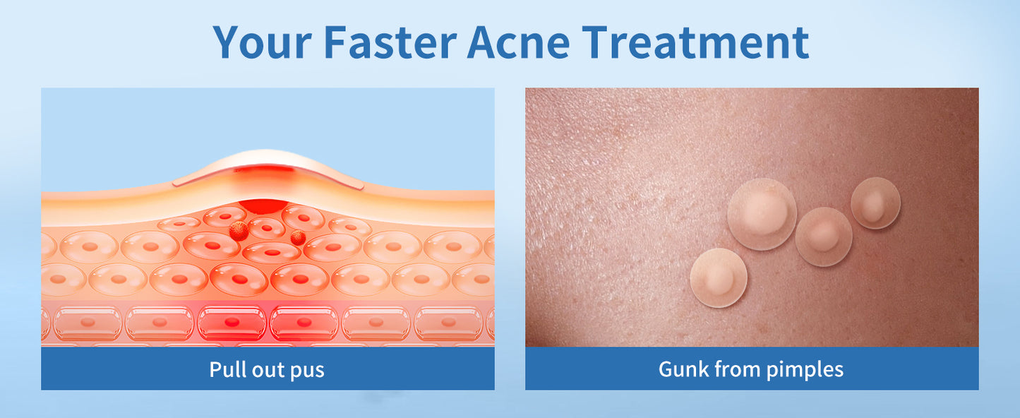 Zermet 1 Pimple Patches for Face, 4 Size 300 Counts Acne Patches, Hydrocolloid Patches for Covering Zits and Blemishes, Spot Stickers with Salicylic Acid, Tea Tree Oil & Calendula Oil