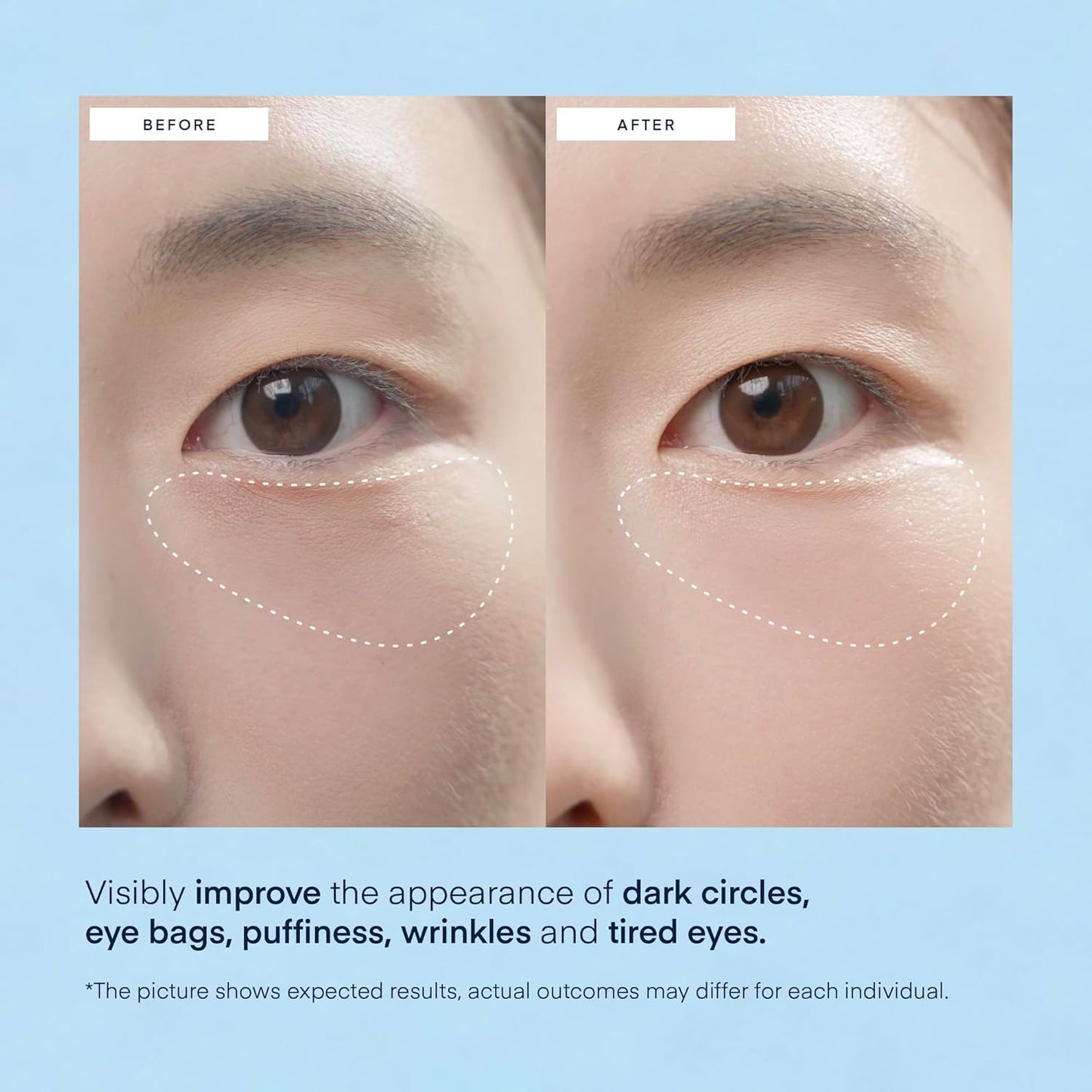 Zermet 1Zermet 1 Under Eye Patches for Dark Circles - 60 Korean Hydrogel Masks for Puffiness, Bags with Caffeine, Hyaluronic Acid, Niacinamide - Undereye Brightening, Hydrating, Anti-Wrinkle & Cooling