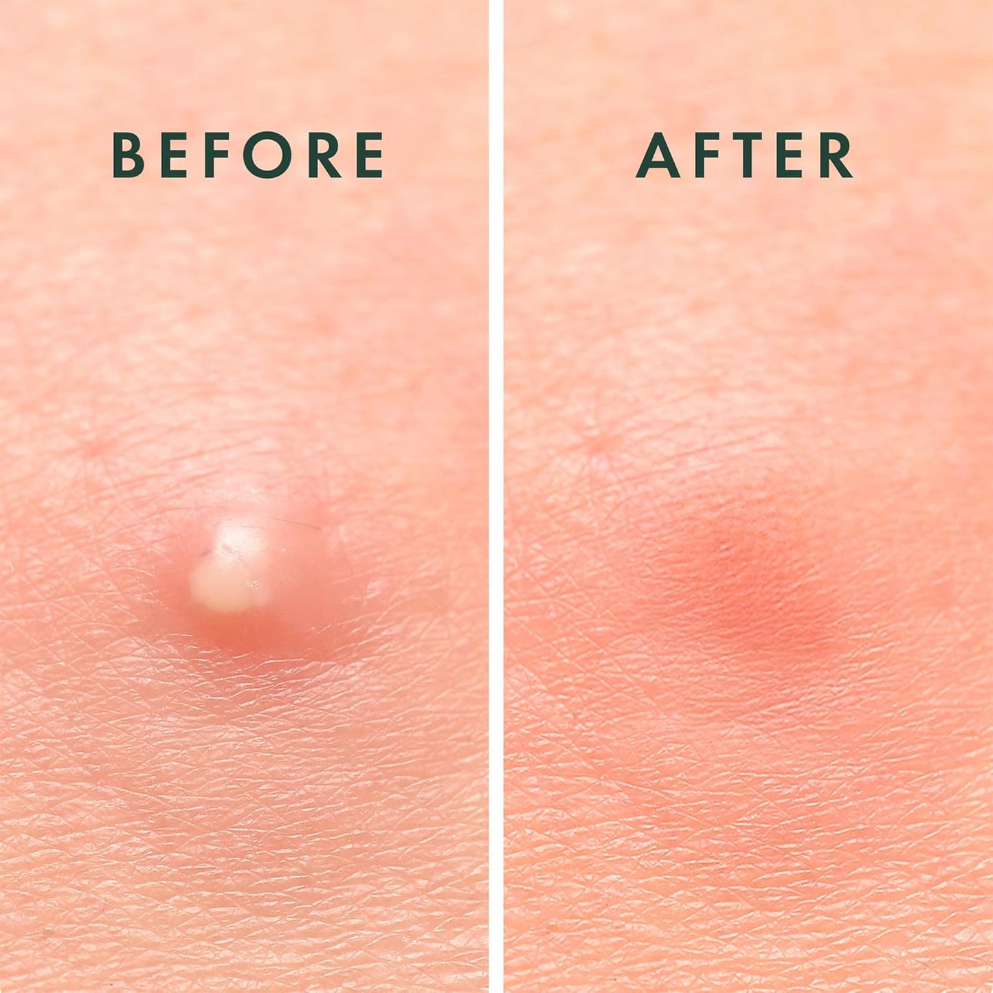 Zermet 1 Rael Pimple Patches, Miracle Invisible Spot Cover - Hydrocolloid Acne Patch, Treatment for Breakouts, Absorbs Zits & Blemish, Korean Skin Care, 2 Sizes (96 Count)