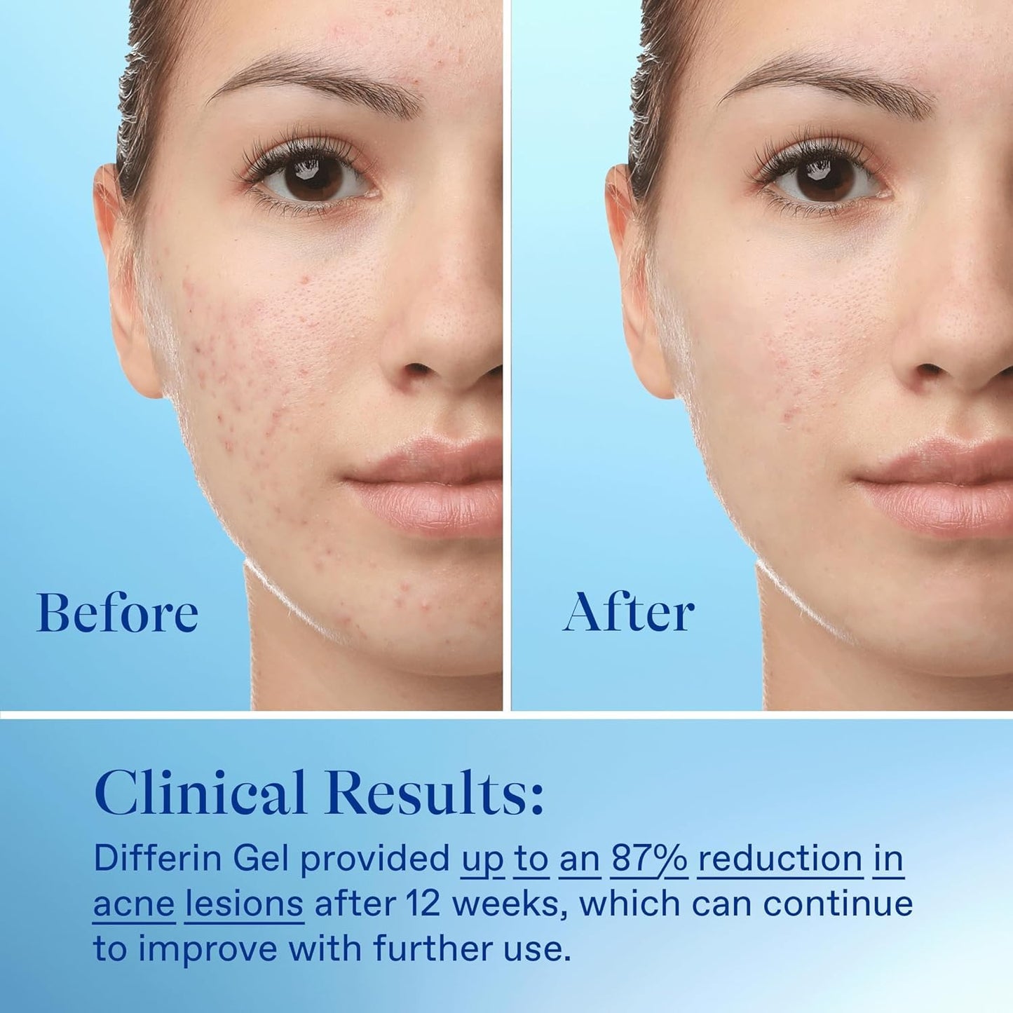 Zermet 1 Differin Acne Treatment Gel, 30 Day Supply, Retinoid Treatment for Face with 0.1% Adapalene, Gentle Skin Care for Acne Prone Sensitive Skin, 15g Tube (Packaging May Vary)