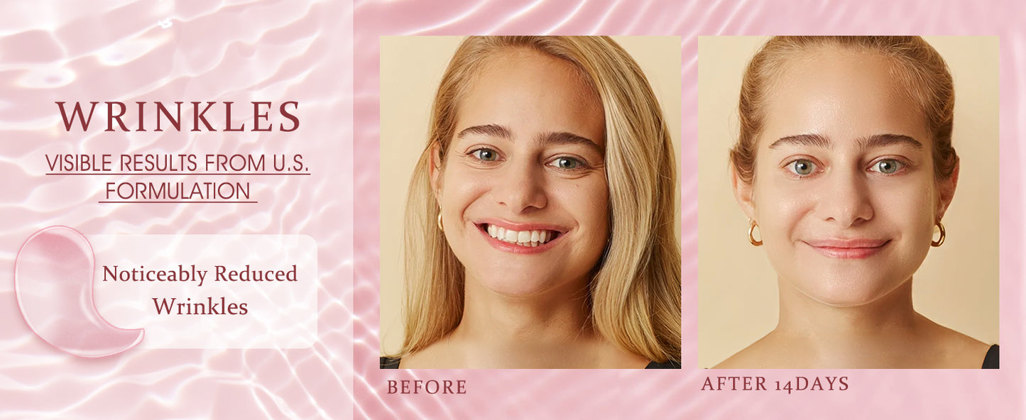 Zermet 1 Under Eye Patches Masks - for Dark Circles, Puffiness, Eye bags,and Fine Lines Smoothing Skin Care Treatment with Collagen and Hyaluronic Acid for Women and Men, (60 Pcs) Pink