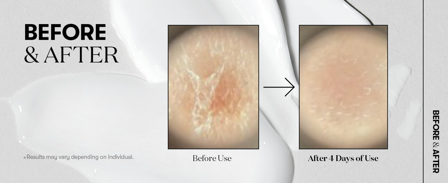 Zermet 1 Zermet 1 Reedle Shot 100, Spicule Microneedling Serum for Pore Care & Exfoliation, Exosome, Centella Asiatica for Glass Skin, Skin Texture, Korean Liquid Skin Booster (1.69 Fl Oz / 50ml)