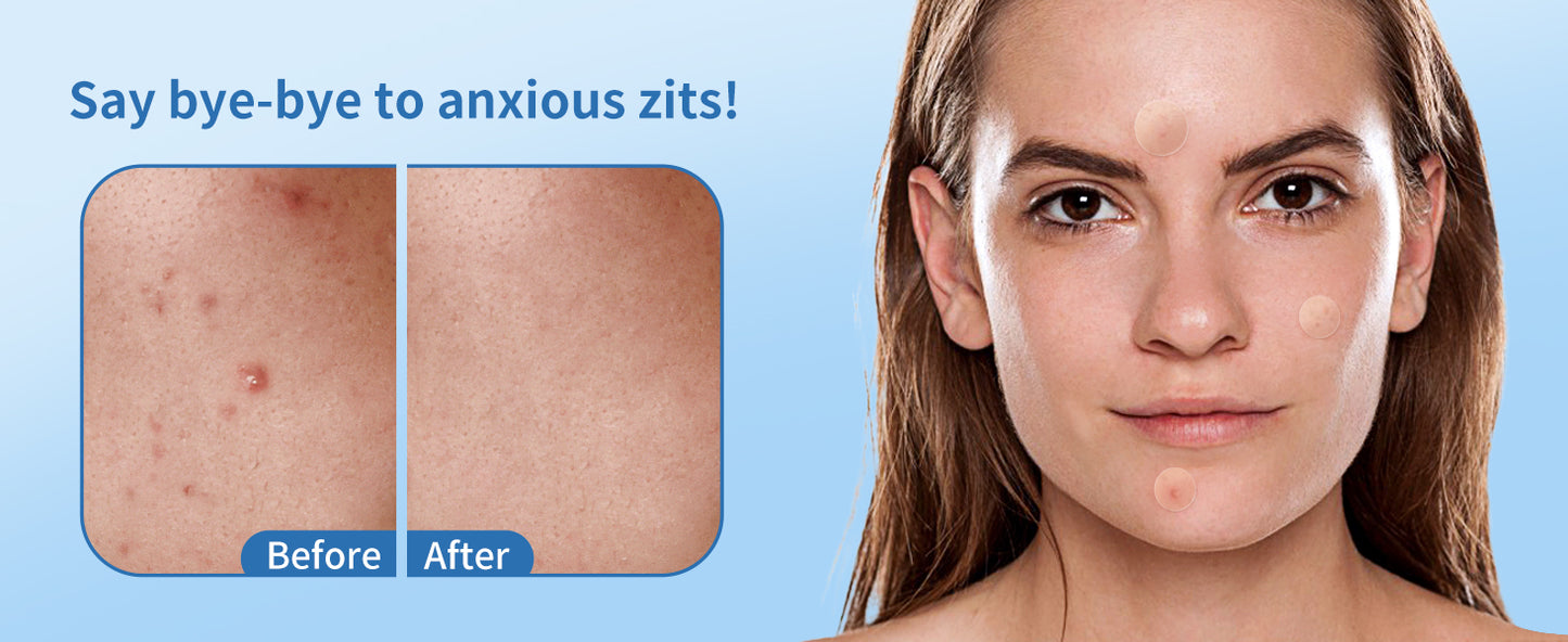 Zermet 1 Pimple Patches for Face, 4 Size 300 Counts Acne Patches, Hydrocolloid Patches for Covering Zits and Blemishes, Spot Stickers with Salicylic Acid, Tea Tree Oil & Calendula Oil