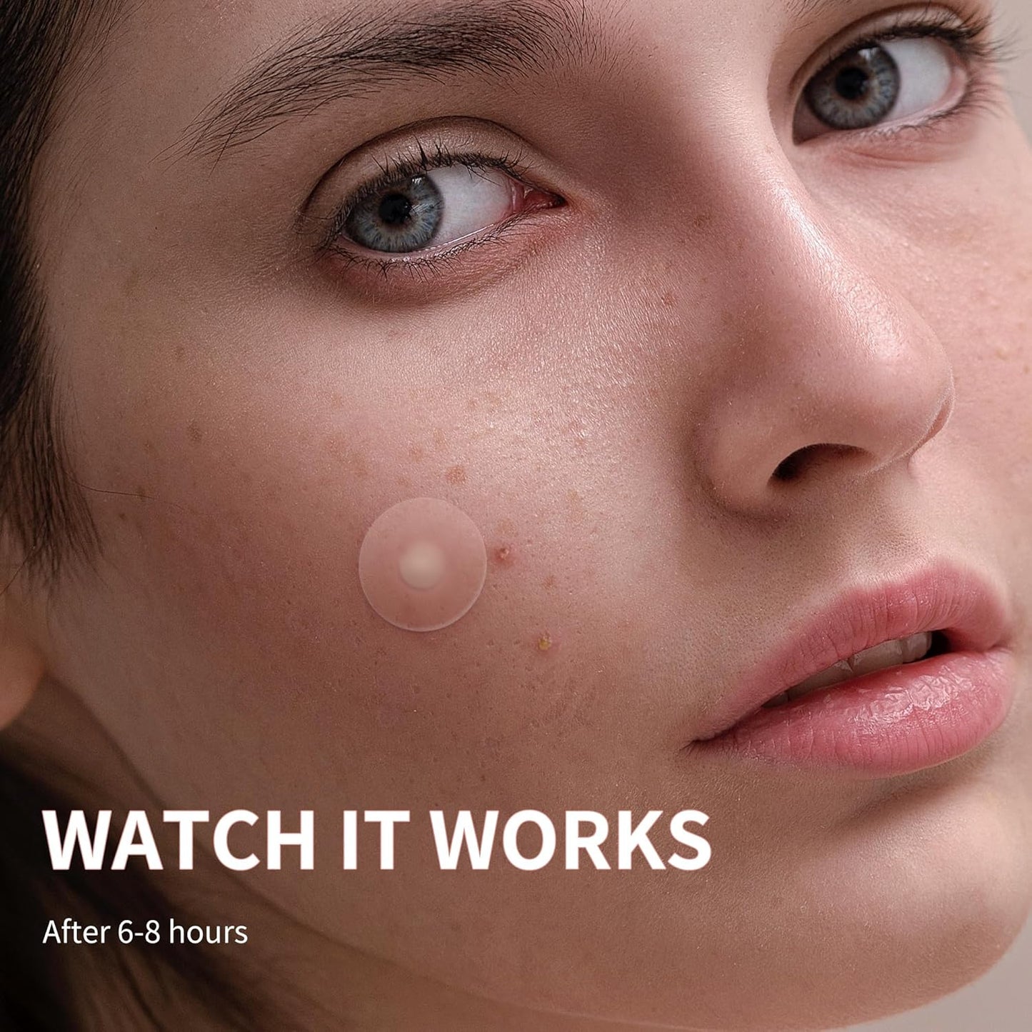 Zermet 1 Pimple Patches for Face, 4 Size 300 Counts Acne Patches, Hydrocolloid Patches for Covering Zits and Blemishes, Spot Stickers with Salicylic Acid, Tea Tree Oil & Calendula Oil