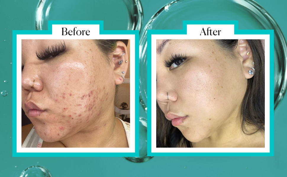 Zermet 1 Zermet 1  Niacinamide Face Serum 12% Plus Zinc 2%, Anti-Aging, Pore Minimizer & Dark Spot Corrector with Hyaluronic Acid & Vitamin E, Vegan & Cruelty-Free, 1 oz