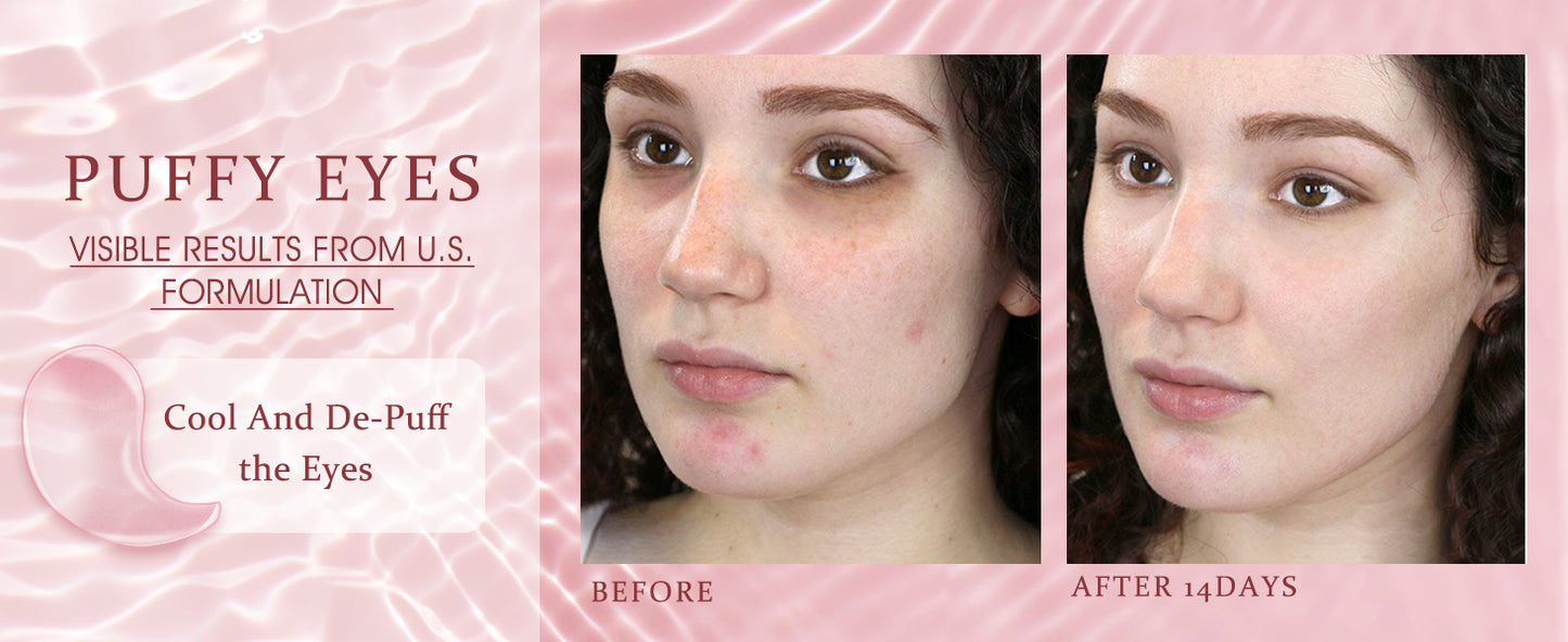 Zermet 1 Under Eye Patches Masks - for Dark Circles, Puffiness, Eye bags,and Fine Lines Smoothing Skin Care Treatment with Collagen and Hyaluronic Acid for Women and Men, (60 Pcs) Pink