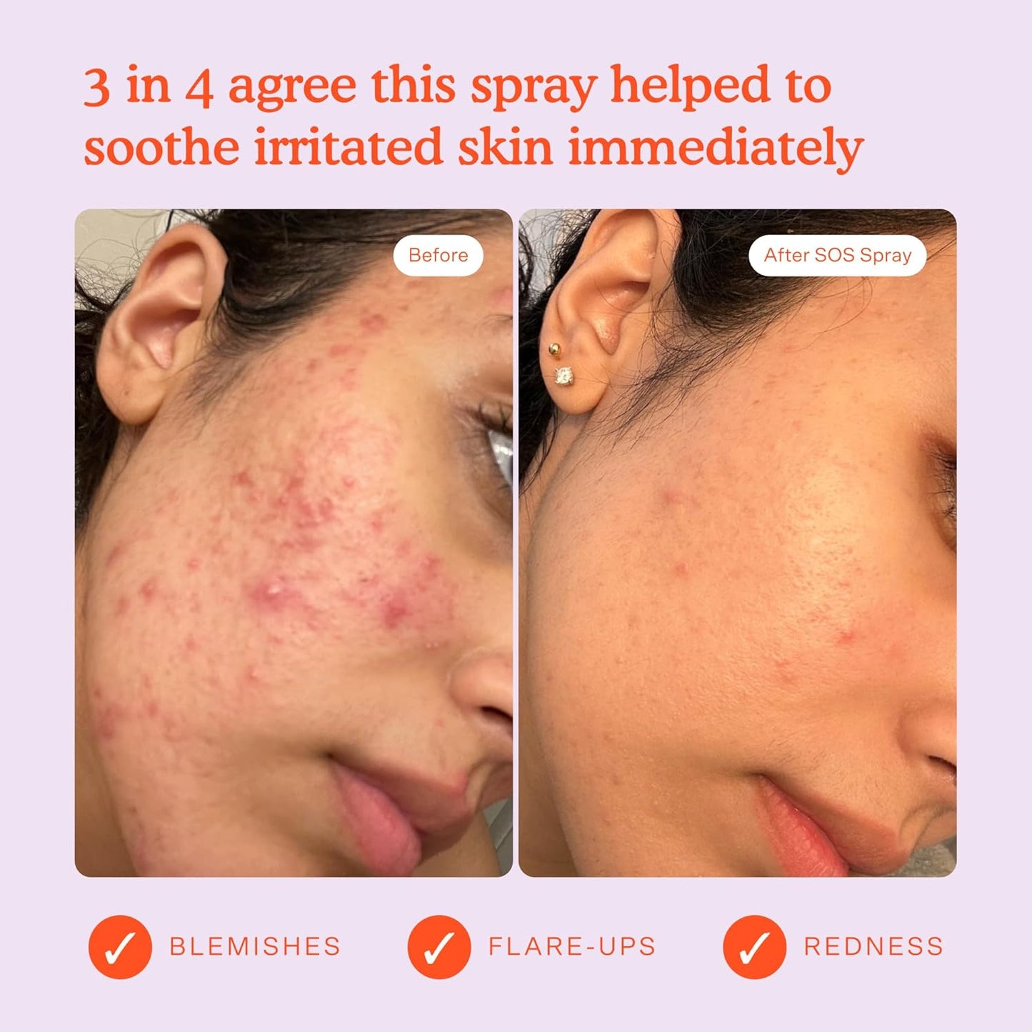 Zermet 1 Tower 28 SOS Daily Rescue Facial Spray for Sensitive Skin, Hypochlorous Acid Spray Helps Reduce Redness and Breakouts, Travel Size Toner for Face, 1 FL Oz