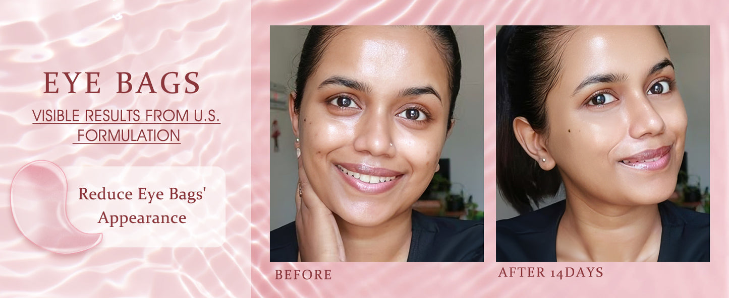 Zermet 1 Under Eye Patches Masks - for Dark Circles, Puffiness, Eye bags,and Fine Lines Smoothing Skin Care Treatment with Collagen and Hyaluronic Acid for Women and Men, (60 Pcs) Pink