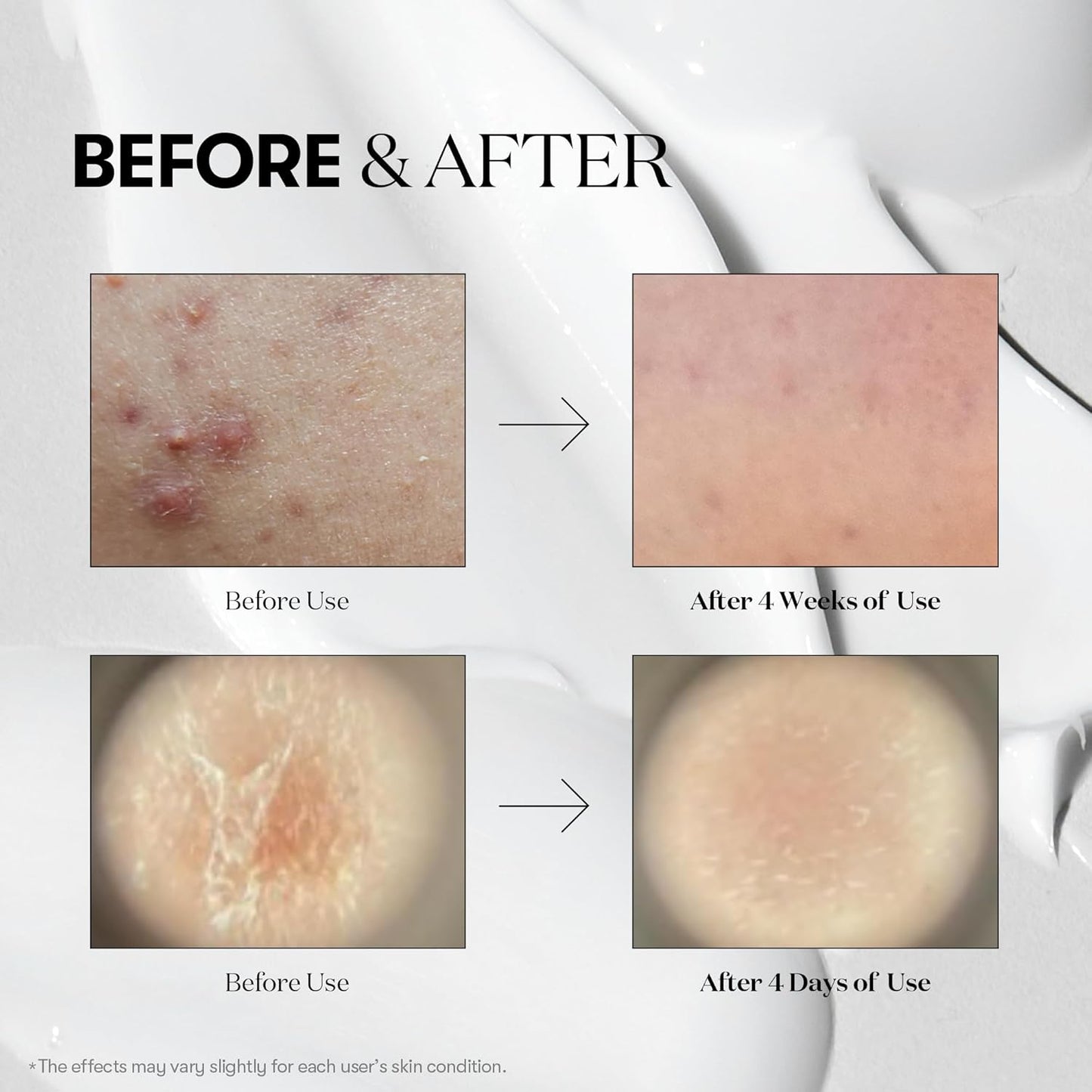 Zermet 1 Zermet 1 Reedle Shot 100, Spicule Microneedling Serum for Pore Care & Exfoliation, Exosome, Centella Asiatica for Glass Skin, Skin Texture, Korean Liquid Skin Booster (1.69 Fl Oz / 50ml)