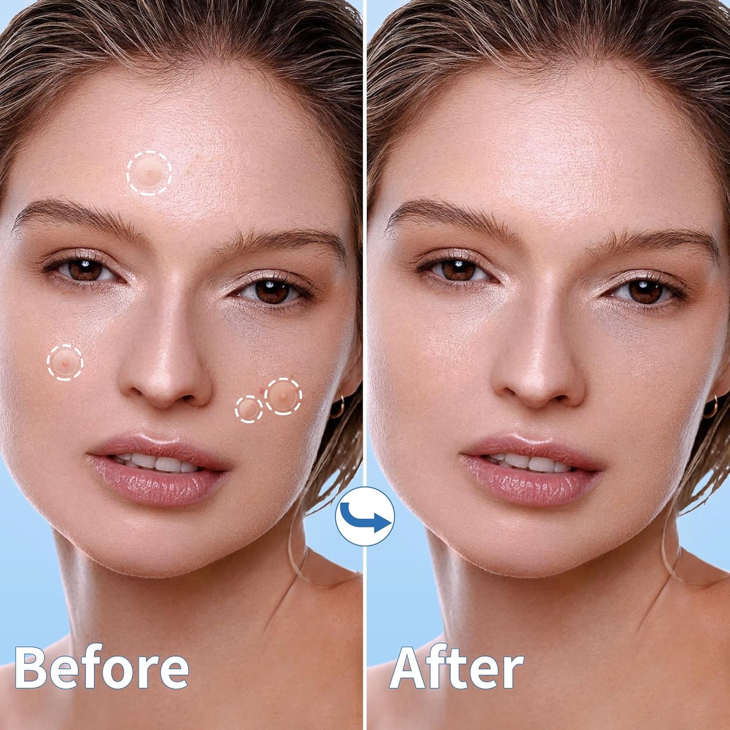 Zermet 1 Pimple Patches for Face, 4 Size 300 Counts Acne Patches, Hydrocolloid Patches for Covering Zits and Blemishes, Spot Stickers with Salicylic Acid, Tea Tree Oil & Calendula Oil