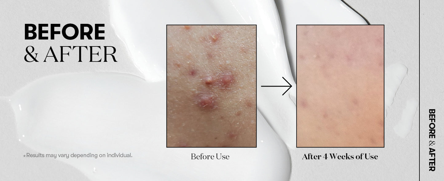 Zermet 1 Zermet 1 Reedle Shot 100, Spicule Microneedling Serum for Pore Care & Exfoliation, Exosome, Centella Asiatica for Glass Skin, Skin Texture, Korean Liquid Skin Booster (1.69 Fl Oz / 50ml)